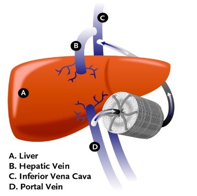 Application of Medical Textiles | Extra-Corporal Devices